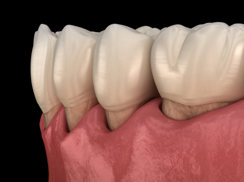 Types of Gum Disease