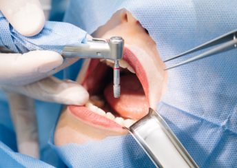 The Long-Term And Short-Term Effects Of Dental Implants 