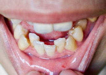 Teeth Straightening Devices: Causes and Effects 