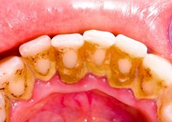 Understanding the Impact of Calculus and Tartar on Dental Health